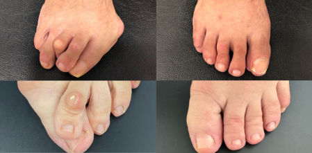 Cirugía mínimamente invasiva del pie