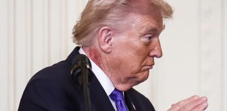 ¿Qué es la mancha roja del cuello de Trump? La opacidad médica reaviva las dudas sobre su salud