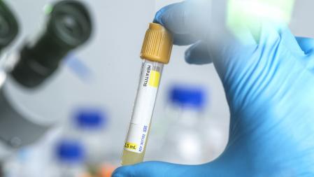 Technician preparing human Hepatitis sample for screening in the lab.