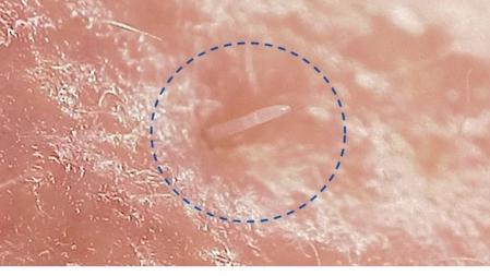 Parte posterior de un ejemplar de 'Demodex folliculorum' sobresaliendo de un poro de piel humana  .