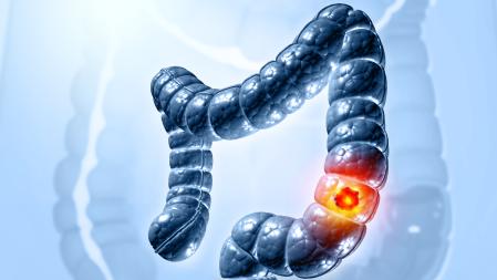 El cáncer de colon es uno de los que tienen más incidencia en España