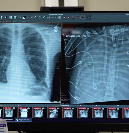 El hombre que vivió 48 horas sin pulmones