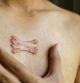 El pecho es una de las zonas más sensibles a la formación de queloides.