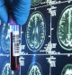 Una muestra de sangre ante imágenes de resonancia magnética de un cerebro