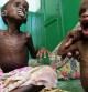Niños somalís desnutridos en el hospital Banadir de Mogadiscio (Somalia)