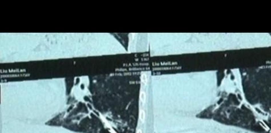 Vive 44 años con un termómetro de mercurio en un pulmón