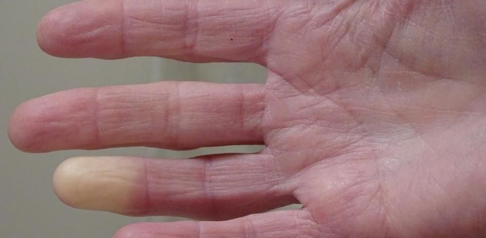 Cómo detectar y aprender a vivir con esclerodermia, una enfermedad que “endurece” la piel