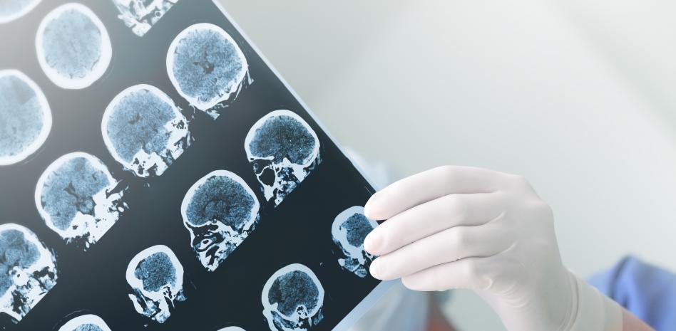 El mayor estudio genómico sobre el alzheimer aclara cómo se origina la enfermedad