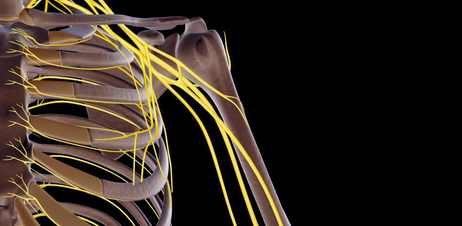 Personas tetrapléjicas recuperan el control de sus manos con una terapia de neuroestimulación