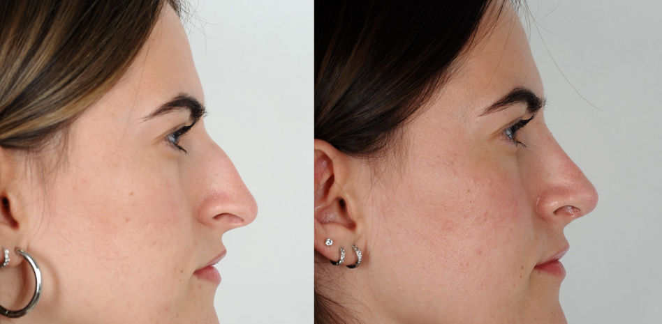 La rinoplastia ultrasónica, clave en la estética nasal