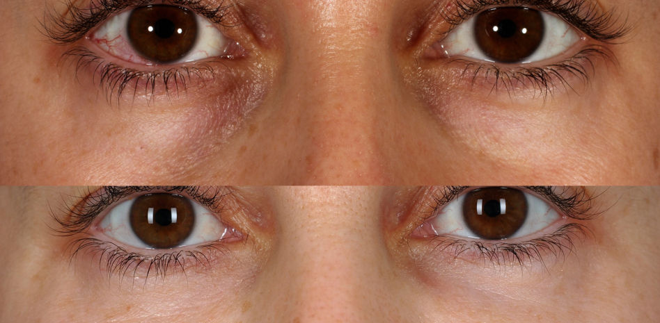 Cómo corregir las ojeras con resultados duraderos