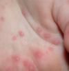 Qué es 'mano-boca-pie', un virus típico en niños que también afecta a adultos