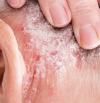 Psoriasis: Entiende sus causas y tratamientos efectivos.