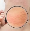 Urticaria con síntomas, causas y cómo aliviar el picor de forma efectiva