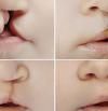 Fisuras labio-palatinas: qué son y las opciones de tratamiento