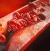 Arterioesclerosis: qué es, síntomas y tratamientos para esta enfermedad cardiovascular