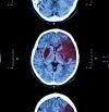 Cómo actuar ante un accidente cerebrovascular: síntomas y tratamientos