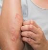 Eccema: cómo reconocer los síntomas y tratar esta afección de la piel