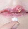 Herpes labial, cómo reconocerlo y tratarlo