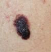 Melanoma: qué es, cómo prevenir y tratar este tipo de cáncer de piel