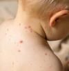 Sarampión: síntomas, causas y cómo tratar esta enfermedad infecciosa