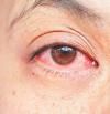 Conjuntivitis: cómo identificar los síntomas y tratarla eficazmente