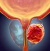 Cáncer de próstata: qué síntomas no debes ignorar y cómo tratar la enfermedad