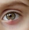 Orzuelo, síntomas y causas de esta molesta afección ocular
