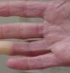 Fenómeno de Raynaud: cómo reconocerlo y tratar los síntomas