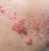 Herpes zóster, síntomas, causas y cómo tratar esta dolorosa enfermedad