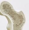 Osteopenia, cómo detectarla y prevenirla