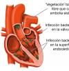 Endocarditis: qué es, síntomas y tratamientos recomendados