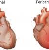 Pericarditis: cómo identificar los síntomas y tratar la inflamación del pericardio