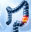 ¿A punto un enfoque innovador para tratar el cáncer colorrectal?