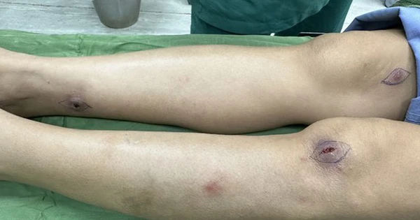 Nguy cơ nhiễm trùng sau cấy chỉ: Cảnh báo và biện pháp phòng ngừa