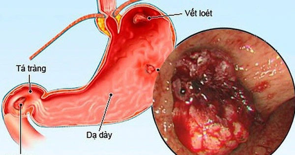 Phòng Ngừa Viêm Loét Dạ Dày Tá Tràng ở Trẻ Em