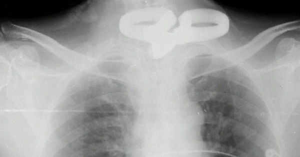 Chuyện kỳ diệu: Người đàn ông mù 2 mắt và cuộc hồi sinh từ sự tự tử