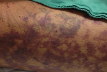 Bí mật đằng sau cơn sốt liên cầu lợn: Nguy cơ và biện pháp phòng tránh