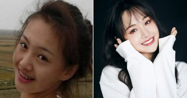 Bí mật niềng răng: Hành trình tìm lại nụ cười hoàn hảo