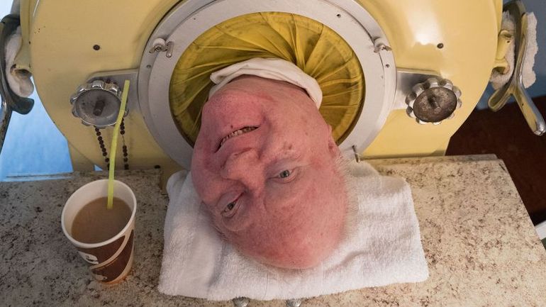 Remarkable Life Journey of Paul Alexander, Iron Lung Survivor Who Passed Away at 78