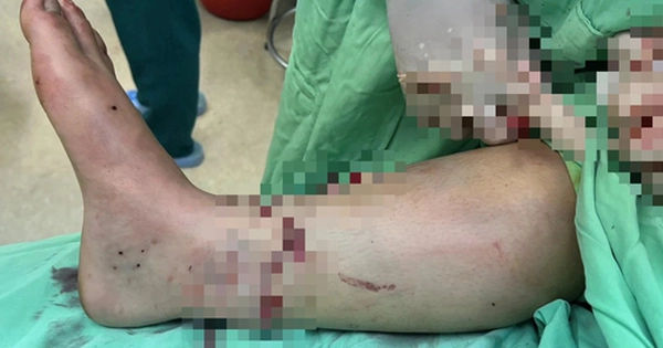 Kỳ tích nối liền đoạn chân phải cho bệnh nhân sau tai nạn giao thông