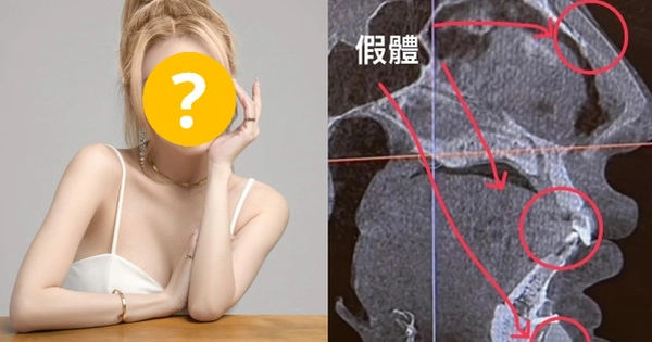 Bí ẩn sau vẻ đẹp: Hành trình phẫu thuật thẩm mỹ đầy bí ẩn của nữ người mẫu Phương Kỳ Viện