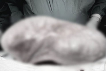 Khám phá câu chuyện đầy kỳ diệu: Bé gái 12 tuổi và khối u khổng lồ trong bụng