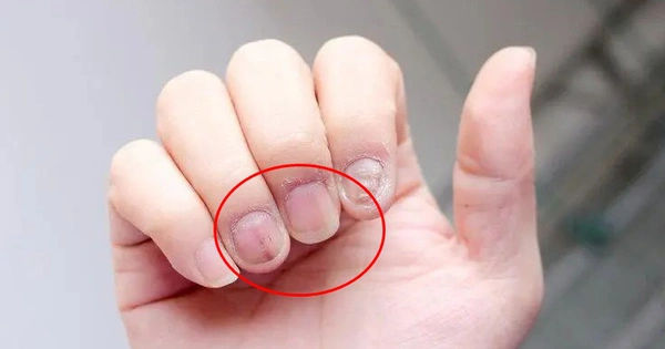 Bàn tay tiết lộ 3 dấu hiệu đặc biệt cho thấy sự xâm lấn của khối u ác tính