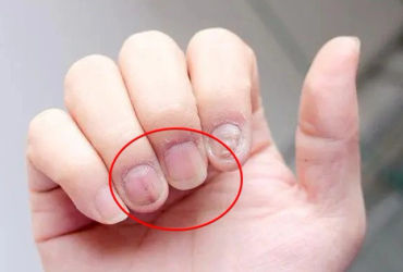 Bàn tay tiết lộ 3 dấu hiệu đặc biệt cho thấy sự xâm lấn của khối u ác tính