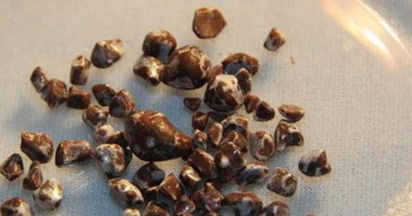 4 thói quen xấu tạo điều kiện cho sỏi thận tích tụ, đặc biệt trong người trẻ