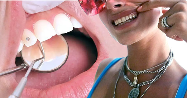Xu hướng đính đá vào răng: Chuyên gia tiết lộ điều quan trọng khi làm