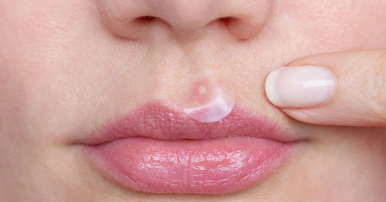 The Ultimate Solution: The #1 Pimple Patch on Amazon for Flawless Skin