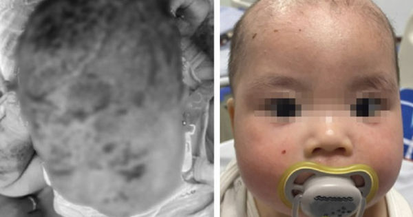 Bí quyết trị viêm da cơ địa cho bé trai: Làn da mặt và đầu mượt mà trở lại sau liệu pháp tắm lá