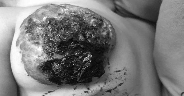 Cắt khối u mạch máu khổng lồ hiếm gặp ở ngực bé 23 tháng tuổi - Hành trình đầy kỳ tích